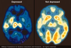 Depressed Brain